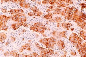 Tumori stampati in 3D: la startup TissueTinker rivoluziona i test oncologici